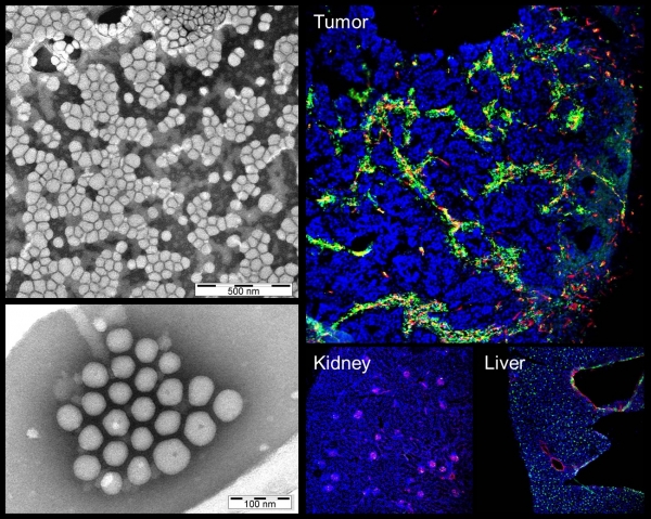 Nanoparticles homing to breast tumor