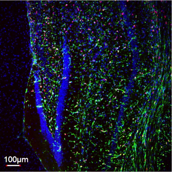 An infiltratively growing patient-derived mouse glioma xenograft P21  developed in our lab expresses nestin (green) and Ki67 (red) positive cells.