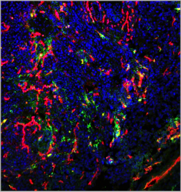 Homing of nanoworm nanoparticles to peritoneal gastric carcinoma ( MKN-45 Nude mice)