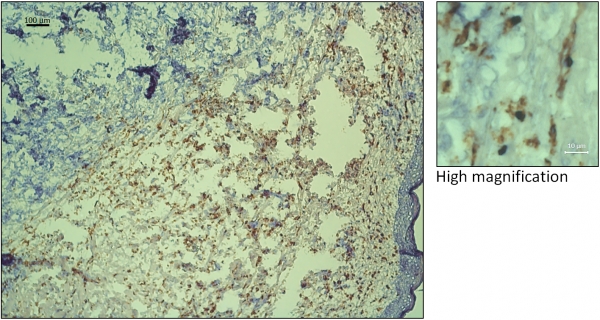 High infiltration of CD206+ cells in human breast tumors
