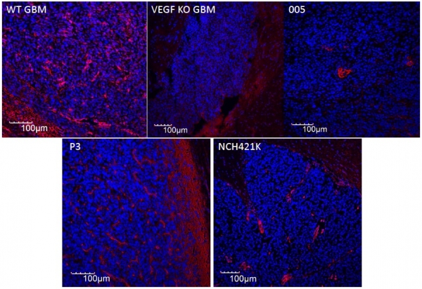 Neuropilin 1 expression (in red) in glioblastoma cell lines used in our lab