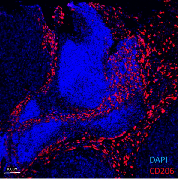 Infiltrating CD206-positive macrophages in peritoneal MKN45P gastric carcinoma xenograft