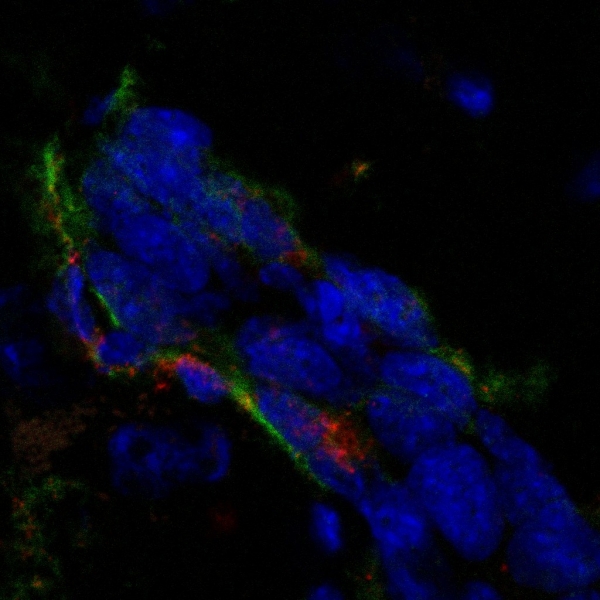 Intravenously injected phage displaying a candidate glioma homing peptide (green) colocalizes with CD68-positive glioma macrophages (red), nuclei-blue.