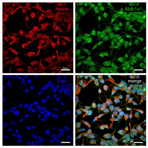 Expression of stem cell markers Aldh1a1 and Nestin in human stem cell like glioblastoma cell line P3